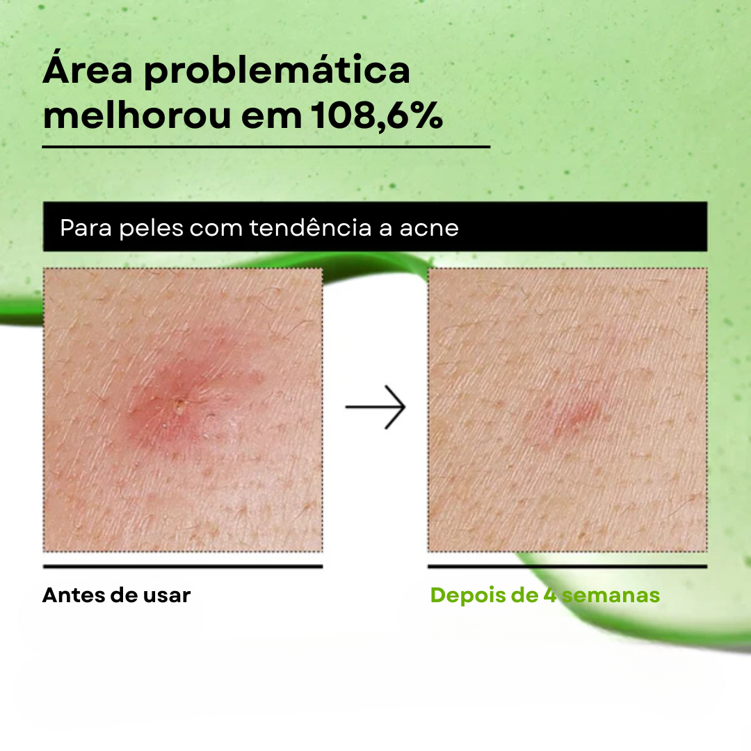 Sérum Calmante com Ácido Azelaico 10% e Ácido Hialurônico